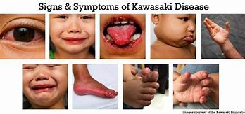 Image result for Kawasaki Virus Symptoms