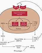 Image result for Atrophic Scar Treatment