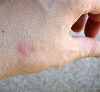 Image result for Bed Bug Bites Row