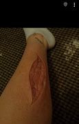 Image result for Skin Laceration Down to the Dermis