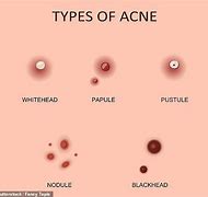 Image result for Big Pimple in the Face