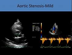 Image result for Aortic Stenosis Doppler