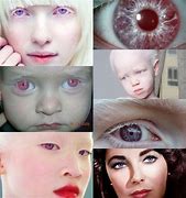 Image result for albino child eyes