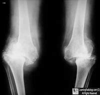 Image result for Charcot Bone Disease