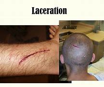 Image result for Skin Laceration Down to the Dermis