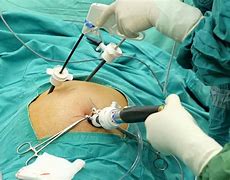 Image result for Open Gallbladder Removal