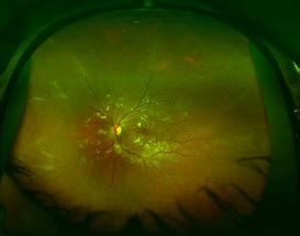 Image result for Uveitis Vision