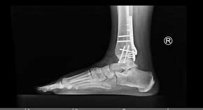 Image result for Surgery for Closed Trimalleolar Ankle Fracture