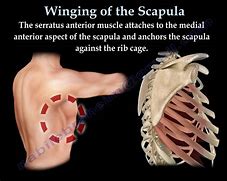 Image result for Winged Scapula Causes