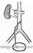 Image result for Retrocaval Ureter X-ray