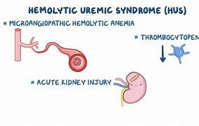 Image result for HUS Hemolytic Uremic Syndrome Triad