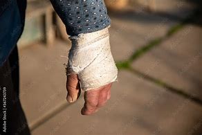 Image result for Swollen Broken Hand