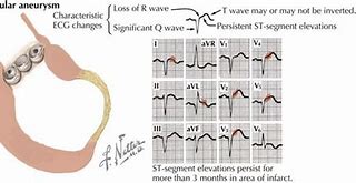 Image result for Dilated Cardiomyopathy EKG