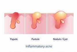 Image result for Pustules and Inflammatory Acne