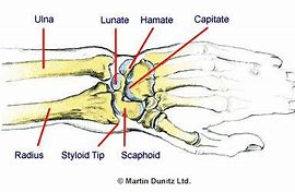 Image result for Capitate Bone Fracture Repair