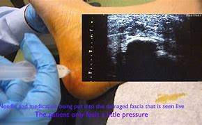 Image result for Plantar Fascia Steroid Injection