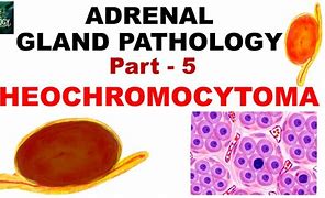 Image result for Light Bulb Sign Pheochromocytoma