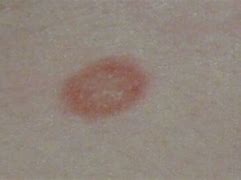 Image result for Small Red Circular Rash On Skin