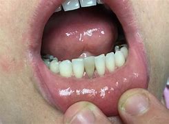 Image result for Root Canal Darkening