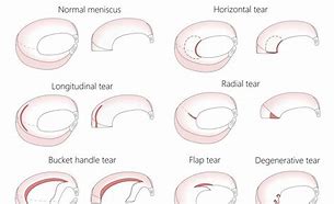 Image result for Flap Tear Meniscus