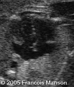 Image result for Right Atrial Appendage Fetal Echo