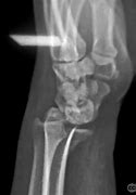 Image result for Volar Fracture