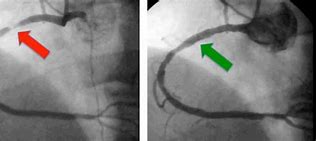 Image result for Coronary Artery Angiography