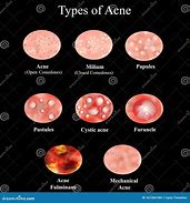 Image result for Pustules and Inflammatory Acne