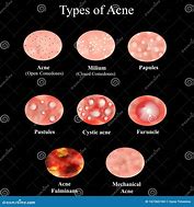 Image result for Pustules and Inflammatory Acne