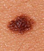 Image result for Skin Cancer On Back of Neck