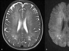 Image result for Toxic Leukoencephalopathy