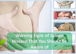 Image result for Spleen Disease Symptoms