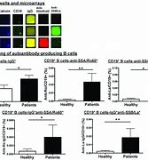 Image result for Anti SSA and Anti SSB