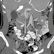 Image result for SCV Thrombosis