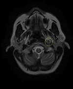 Image result for Distal Carotid Aneurysm MRI