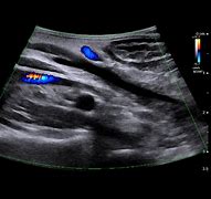 Image result for Cholecystectomy Ultrasound