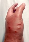 Image result for Cat Bite On Finger