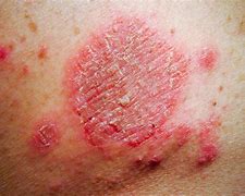 Image result for Eczema On Black Skin with Grey Colour