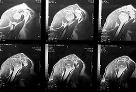 Image result for Shoulder MRI