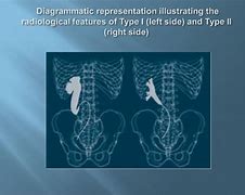 Image result for Retrocaval Ureter X-ray