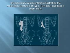 Image result for Retrocaval Ureter vs Normal