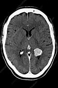 Image result for Meningioma CT Head