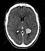 Image result for Subfalcine Meningioma CT