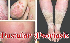 Image result for Psoriatic Pustules