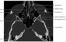 Image result for Sphenopalatine Foramen Radiology