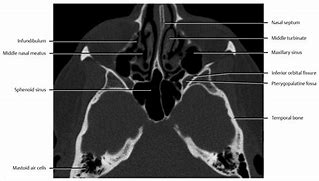 Image result for Sphenopalatine Foramen Radiology