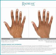 Image result for Radiesse for Face