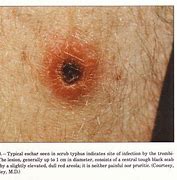 Image result for Epidemic Typhus