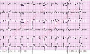 Image result for Bigeminy PVC ECG