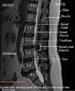 Image result for Lumbar and Sacral Spine